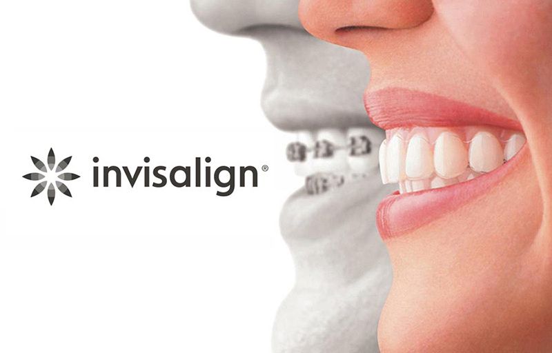 invisalign traitement orthodontie avis
