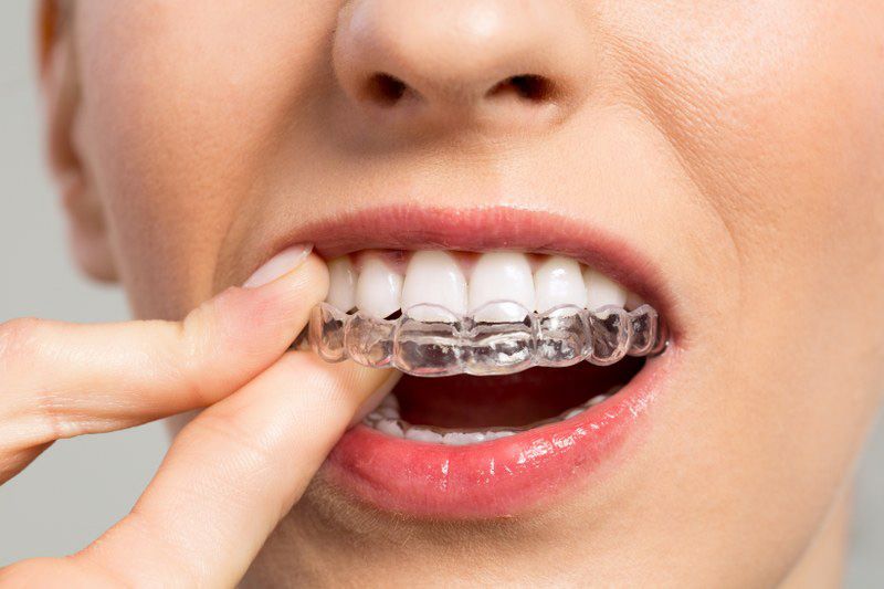 traitement invisalign avis