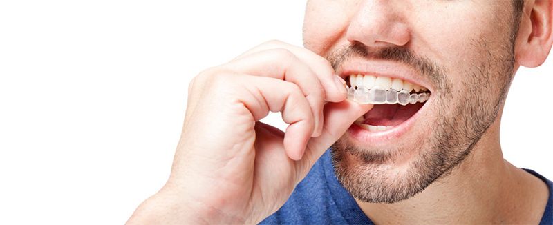 traitement invisalign selon complexite avis