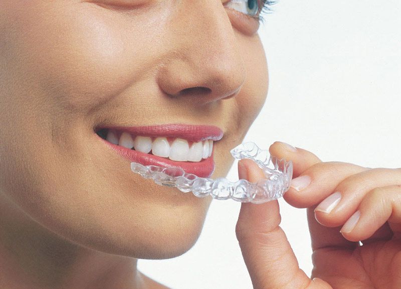 vie quotidienne invisalign avis
